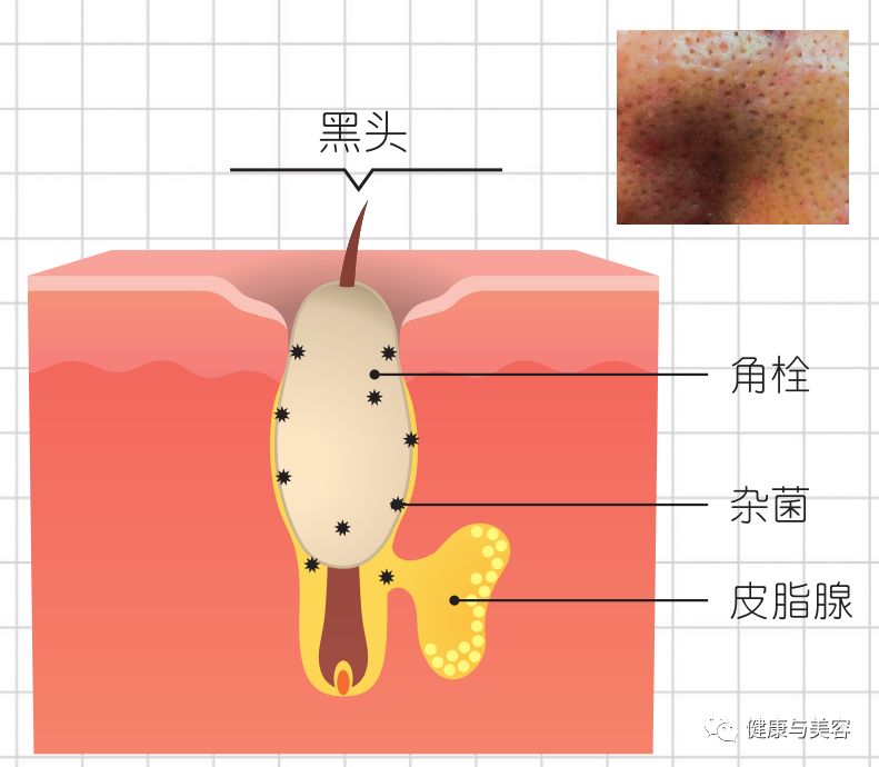 痘印日常_痘印心得经验_痘印的解决方法