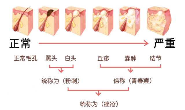 痘印的烦恼_痘印心得经验_痘印的解决方法