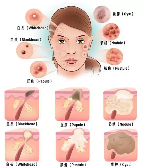 痘印心得经验_痘印日常_痘印的解决方法