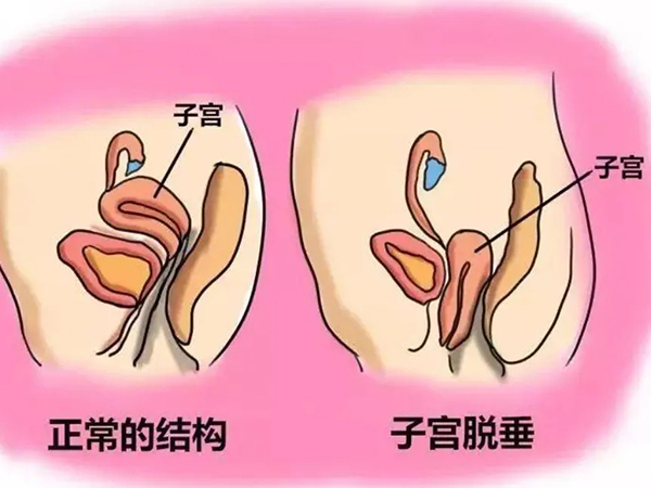 子宫脱垂一、二、三度真实图片分享，从症状可了解分级情况