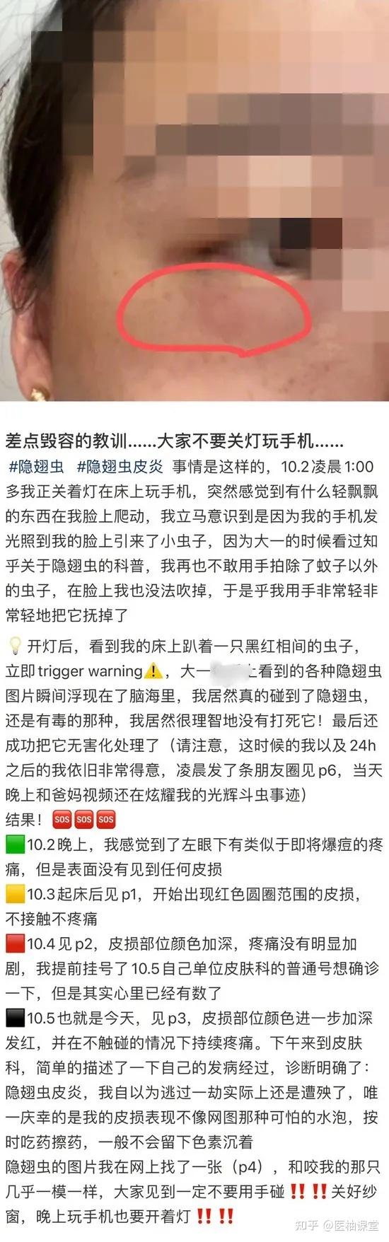 一条小虫，差点毁容！遇到这样的小虫千万不能拍！