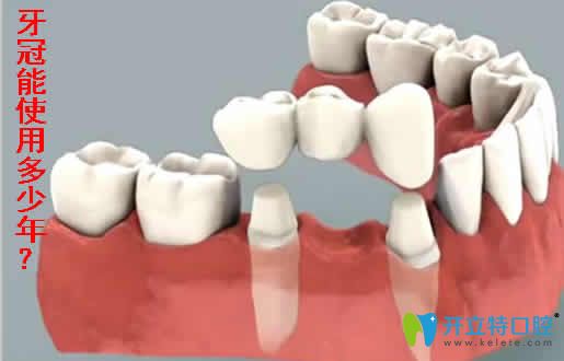 牙冠能使用多少年