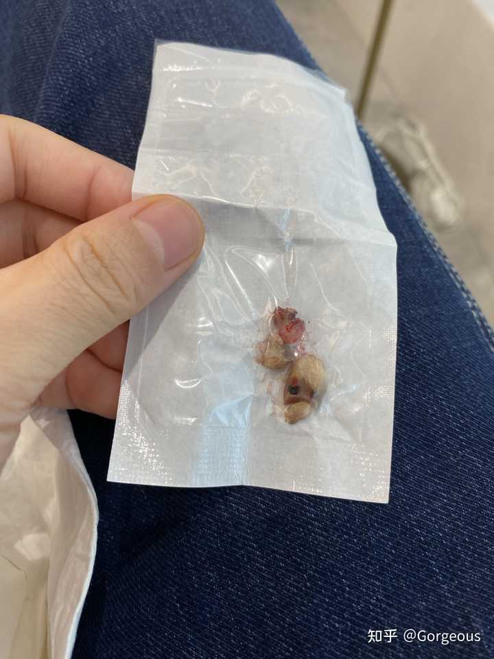 种植牙真的可怕吗？有过种植牙经历的童鞋来分享下种植感受？