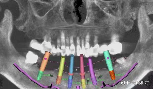 5分钟让你get数字化种植牙的全过程！
