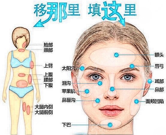 脂肪填充15天恢复照片